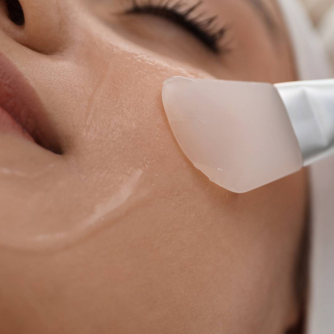 Peeling Químico