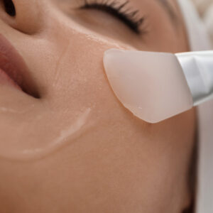 Peeling Químico